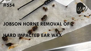 554 - Jobson Horne Removal of Hard Impacted Ear Wax