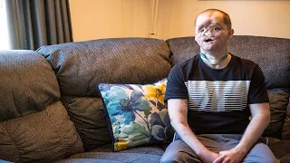 Michigan man seeking face transplant shares his story