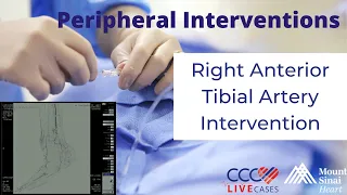 Right Anterior Tibial Artery Intervention - February 25, 2015 Live Case Video