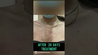 Best Back Acne Treatment in Punjab | Is Back Acne curable? Dr Ashima Goel| PARISA skin clinic