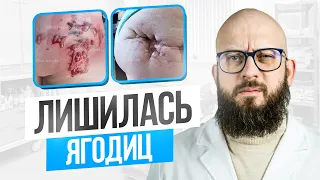 Хотела убрать ямочки на попе, а ЛИШИЛАСЬ ЯГОДИЦ! Опасности косметологических процедур на 5й точке