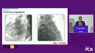 Relief for the unrelievable: the role of the Reducer for refractory angina - EuroPCR 2024