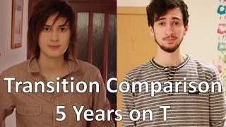 FTM Transgender: 5 Years on Testosterone Comparison