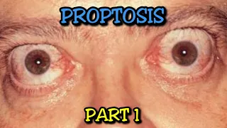 Understanding Proptosis (Part 1): Exploring Preseptal & Orbital Cellulitis