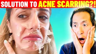 Plastic Surgeon Reacts to Face PEELING OFF From Chemical Peel!