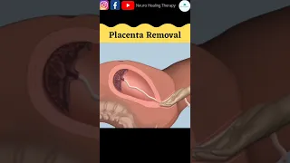 Placenta Removal #shorts #baby