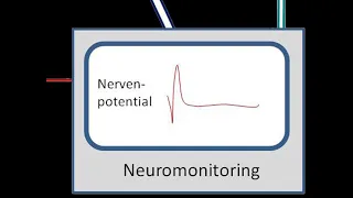 Multimodal Neuro monitoring