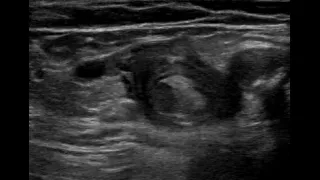 Deep venous thrombosis, DVT ultrasound.  12/2021.