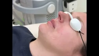 Лазерна діодна епіляція верхньої губи