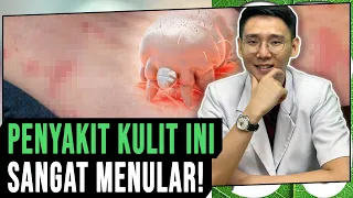 Penyakit Kulit Ini Sangat Menular (Scabies/Kudis)