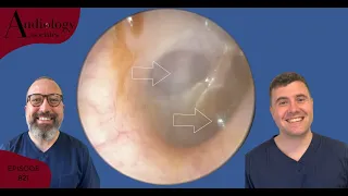 EAR WAX REMOVAL COMPILATION INC MIDDLE EAR EFFUSION- EP821