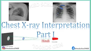 Chest X-ray interpretation made easy Hindi