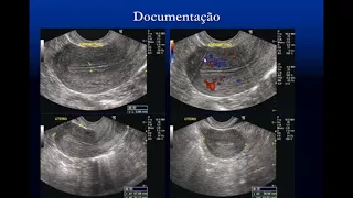 US Doppler da Pelve Feminina