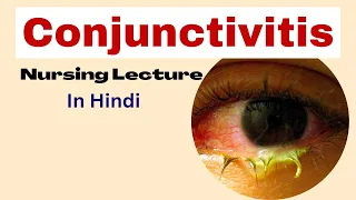 conjunctivitis in hindi | type,cause, symptoms, management | Eye disease nursing lecture | msn