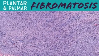 Plantar & Palmar Fibromatosis (Ledderhose Disease & Dupuytren Contracture/Trigger Finger) pathology
