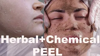 Herbal Skin Peel - Best Acne Treatment - Full procedure+before & after pictures