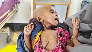 Засуха в Сомали набирает обороты, начали гибнуть дети
