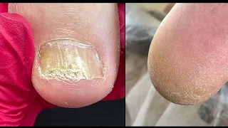 Pedicure / Foot treatment