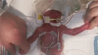 Meet Premature Twins Born with Potentially Fatal Holes in Their Heart