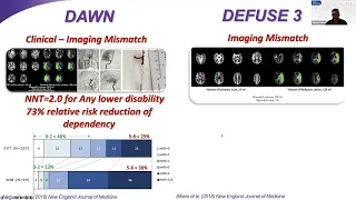 Dr. Amrou Sarraj, MD - Endovascular thrombectomy for large core ischemic stroke