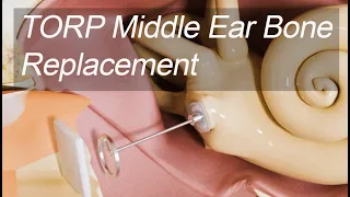 Middle Ear Bone Total Replacement - Total Ossicular Replacement Prosthesis (TORP) for Hearing Loss