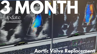 3 Month Update - Post Aortic Valve Replacement Surgery