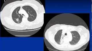 Curing and Controlling Lung Cancer...Can it be done?