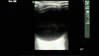 Ocular Ultrasound: Vitreous Hemorrhage