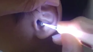 Hard Giant Earwax Removal