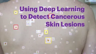 Using deep learning to detect cancerous skin lesions FINAL