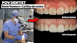 AMAZING Injected Resin Veneers | Dentist POV