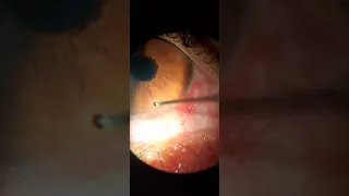 Corneal Foreign body removal