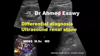 ULTRASOUND RENAL STONE DIFFERENTIAL DIAGNOSIS