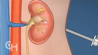 Percutaneous Nephrolithotomy (PCNL) for Kidney Stones in Children