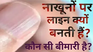 #नाखून पर यदि लाइन बन जाए तो उसका क्या मतलब होता है?#Nail पर लाइन बन जाए तो क्या करें?