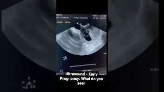 Ultrasound in early pregnancy: What do you see!