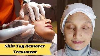 NGILANGIN SKIN TAG/KUTIL Ngga Pakai Mahal di Salsa Beauty Centre