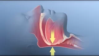 Obstructive Sleep Apnea - Mayo Clinic