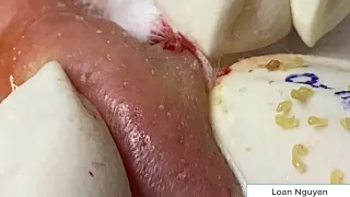 Blackheads extraction with Loan Nguyen Spa (n10)