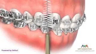 Life with Braces - Brushing Between Braces