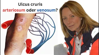 Was ist der Unterschied zwischen einem ulcus cruris arteriosum und venosum?