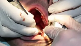 Root Canal Surgery