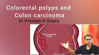 Colorectal polyps